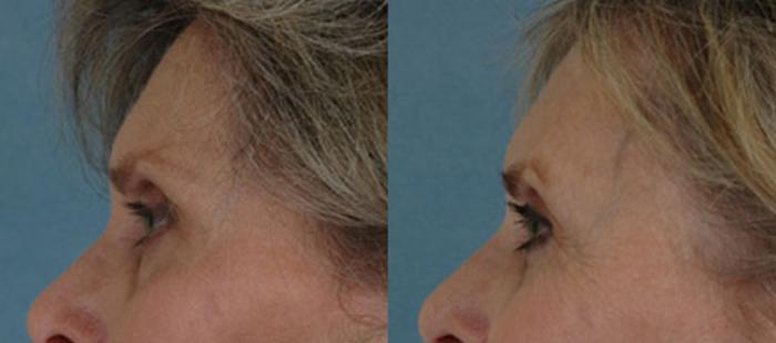 Before & After Eyelid Surgery (Blepharoplasty) Case 32 View #3 View in Tallahassee, FL