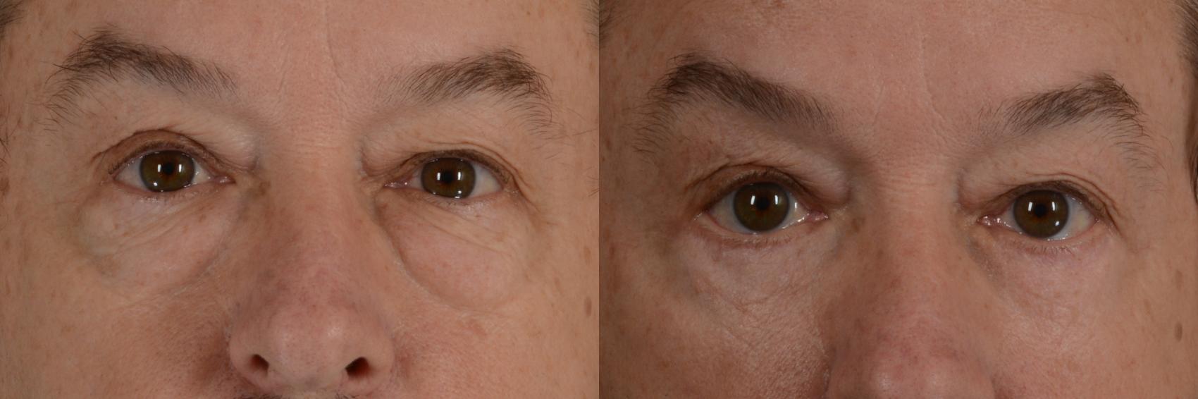 Before & After Eyelid Surgery (Blepharoplasty) Case 320 View #1 View in Tallahassee, FL
