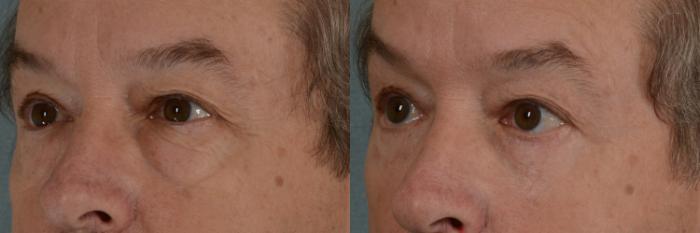 Before & After Eyelid Surgery (Blepharoplasty) Case 320 View #2 View in Tallahassee, FL