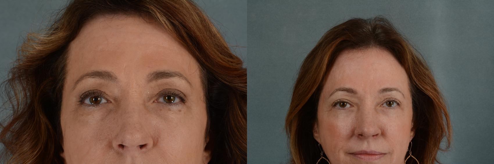 Before & After Eyelid Surgery (Blepharoplasty) Case 321 View #1 View in Tallahassee, FL