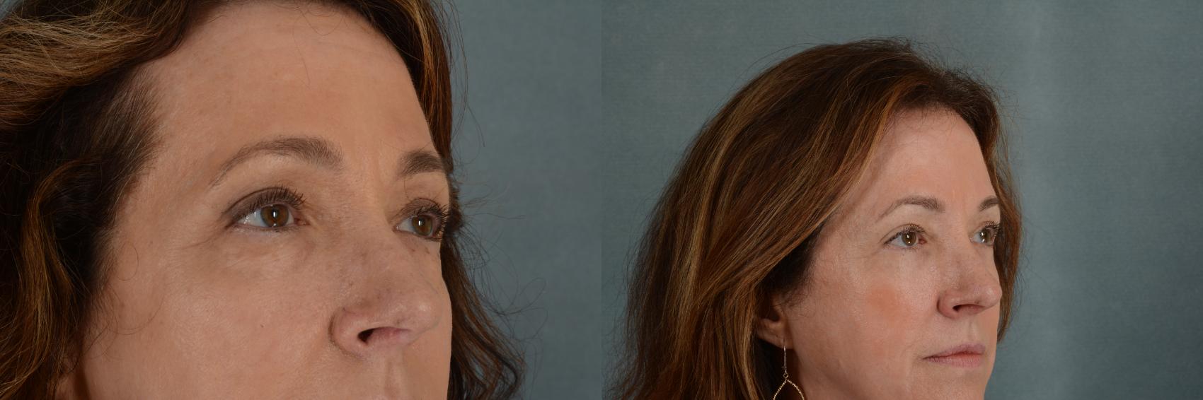 Before & After Eyelid Surgery (Blepharoplasty) Case 321 View #2 View in Tallahassee, FL