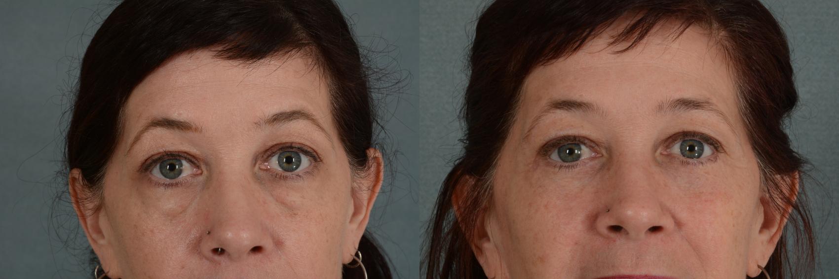 Before & After Eyelid Surgery (Blepharoplasty) Case 322 View #1 View in Tallahassee, FL