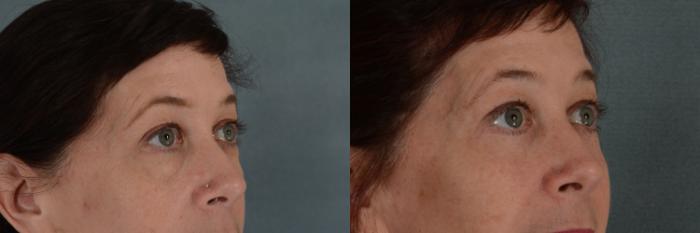 Before & After Eyelid Surgery (Blepharoplasty) Case 322 View #2 View in Tallahassee, FL