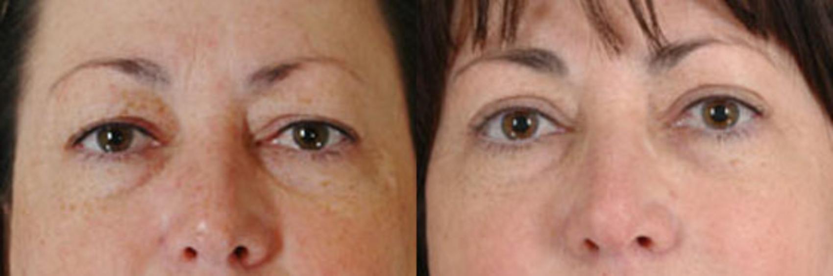 Before & After Eyelid Surgery (Blepharoplasty) Case 33 View #1 View in Tallahassee, FL