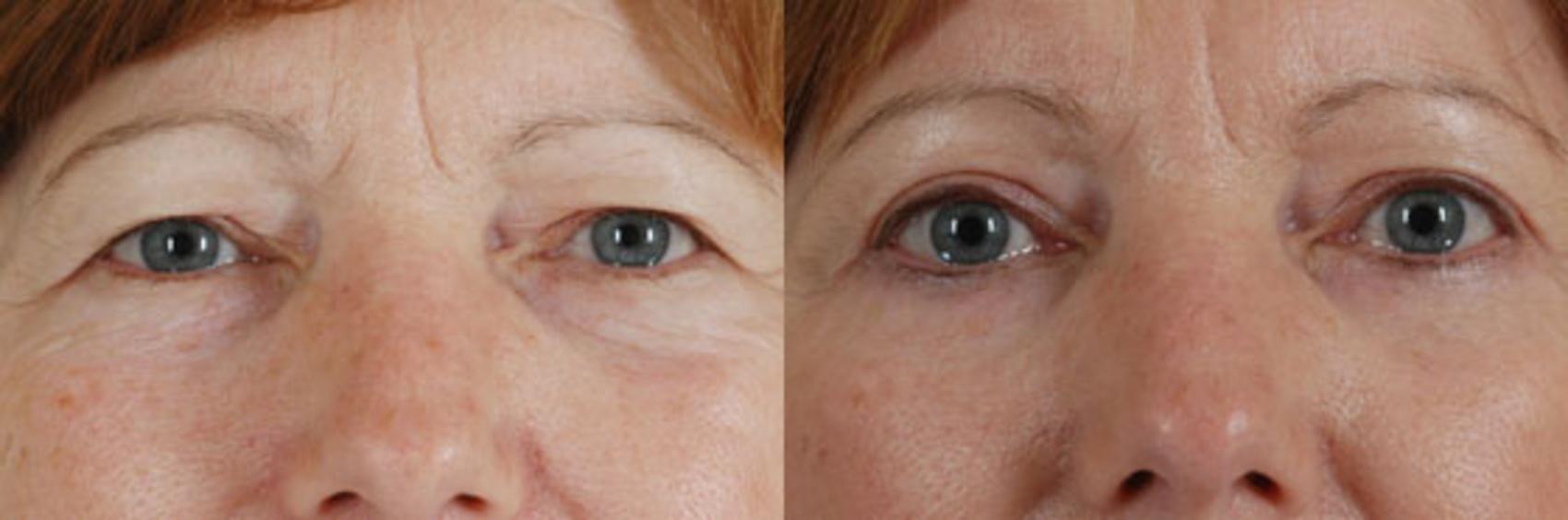 Before & After Eyelid Surgery (Blepharoplasty) Case 34 View #1 View in Tallahassee, FL