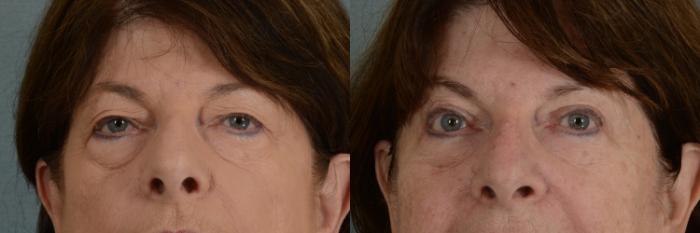 Before & After Eyelid Surgery (Blepharoplasty) Case 343 View #1 View in Tallahassee, FL