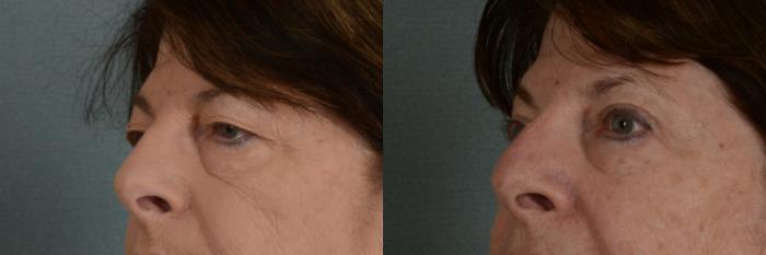 Before & After Eyelid Surgery (Blepharoplasty) Case 343 View #2 View in Tallahassee, FL
