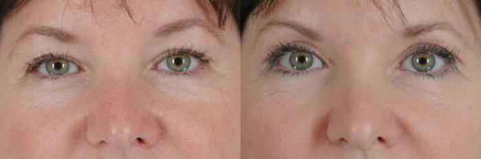 Before & After Eyelid Surgery (Blepharoplasty) Case 35 View #1 View in Tallahassee, FL