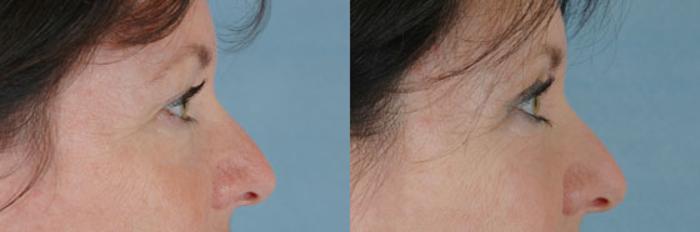Before & After Eyelid Surgery (Blepharoplasty) Case 35 View #2 View in Tallahassee, FL
