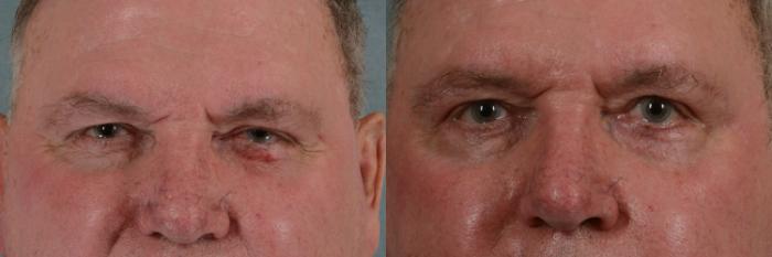 Before & After Eyelid Surgery (Blepharoplasty) Case 351 View #1 View in Tallahassee, FL