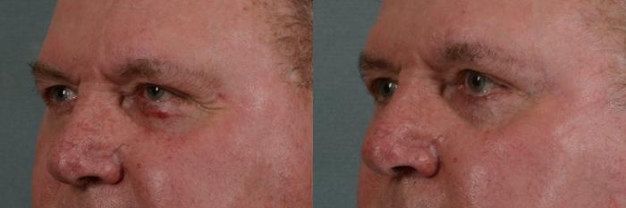 Before & After Eyelid Surgery (Blepharoplasty) Case 351 View #2 View in Tallahassee, FL