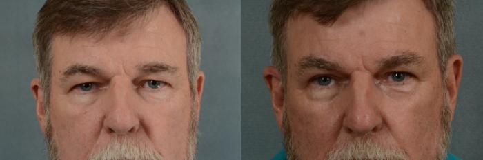 Before & After Eyelid Surgery (Blepharoplasty) Case 358 View #1 View in Tallahassee, FL