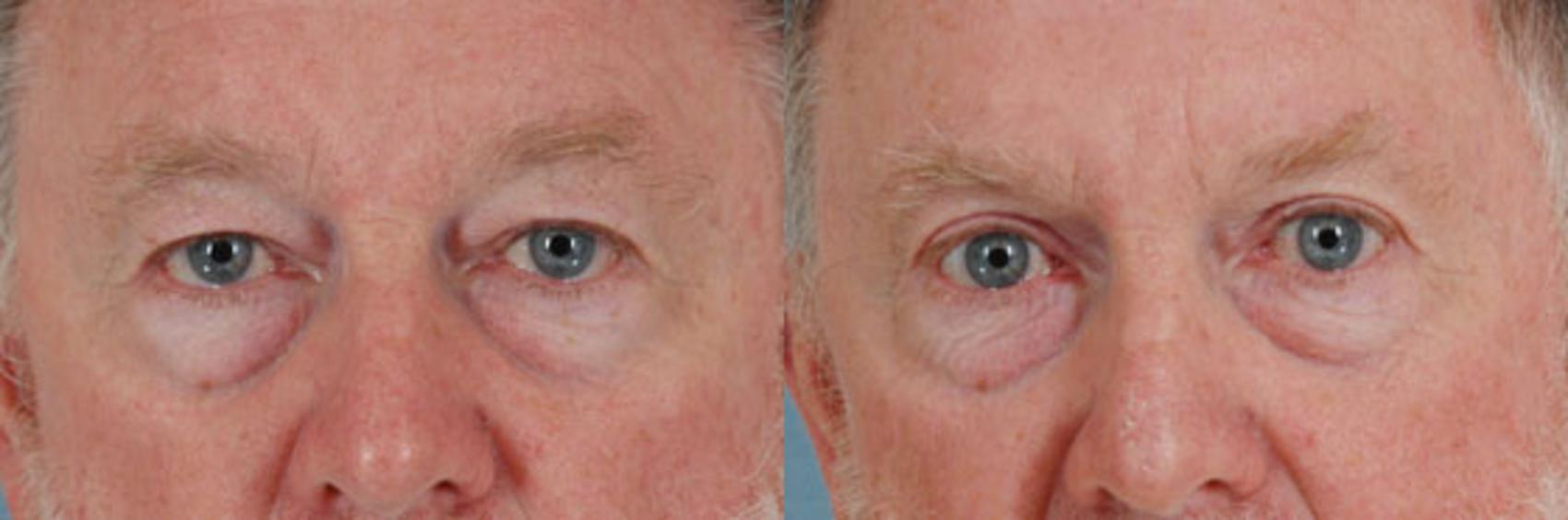 Before & After Eyelid Surgery (Blepharoplasty) Case 36 View #1 View in Tallahassee, FL