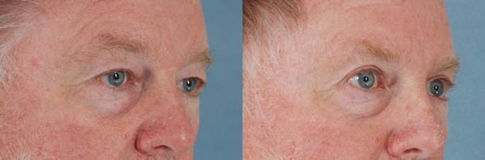 Before & After Eyelid Surgery (Blepharoplasty) Case 36 View #2 View in Tallahassee, FL