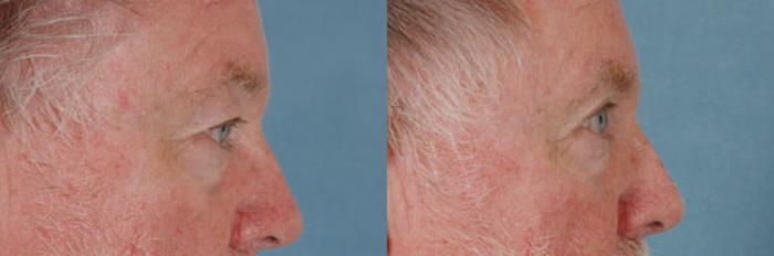 Before & After Eyelid Surgery (Blepharoplasty) Case 36 View #3 View in Tallahassee, FL