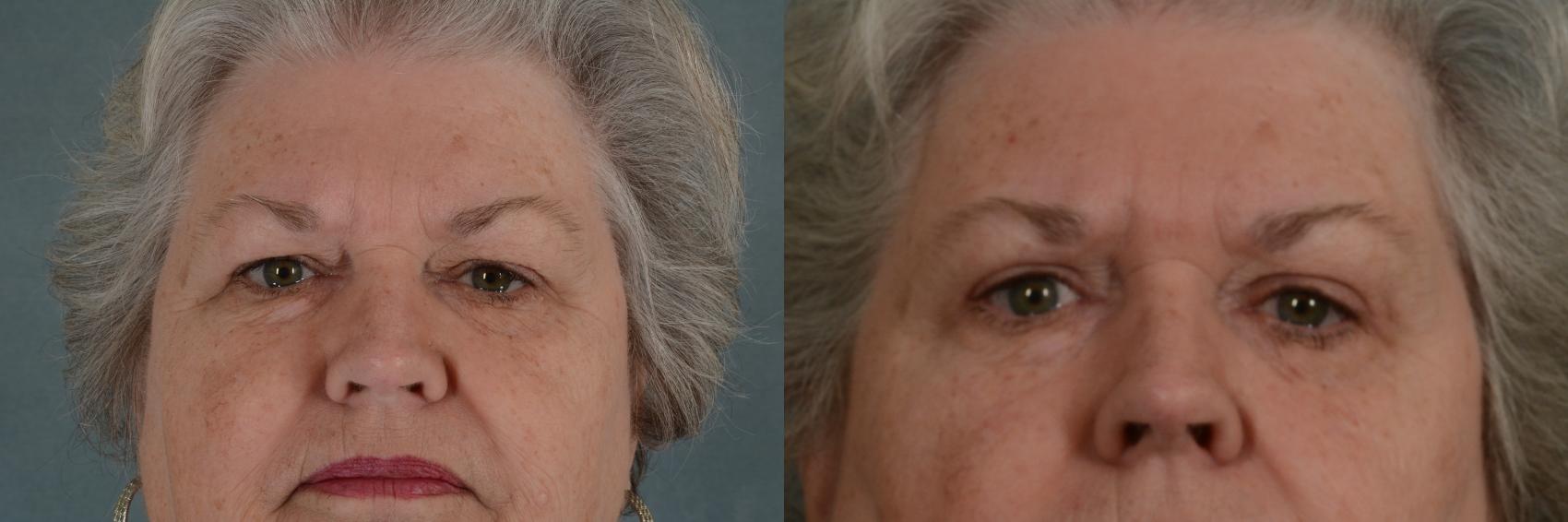 Before & After Eyelid Surgery (Blepharoplasty) Case 366 View #1 View in Tallahassee, FL