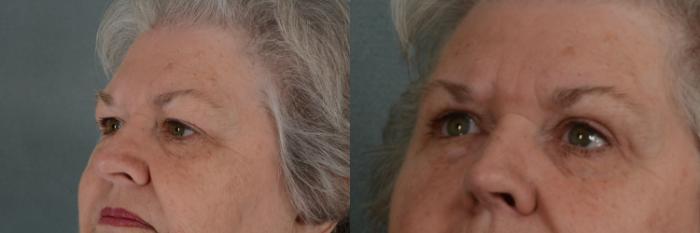 Before & After Eyelid Surgery (Blepharoplasty) Case 366 View #2 View in Tallahassee, FL