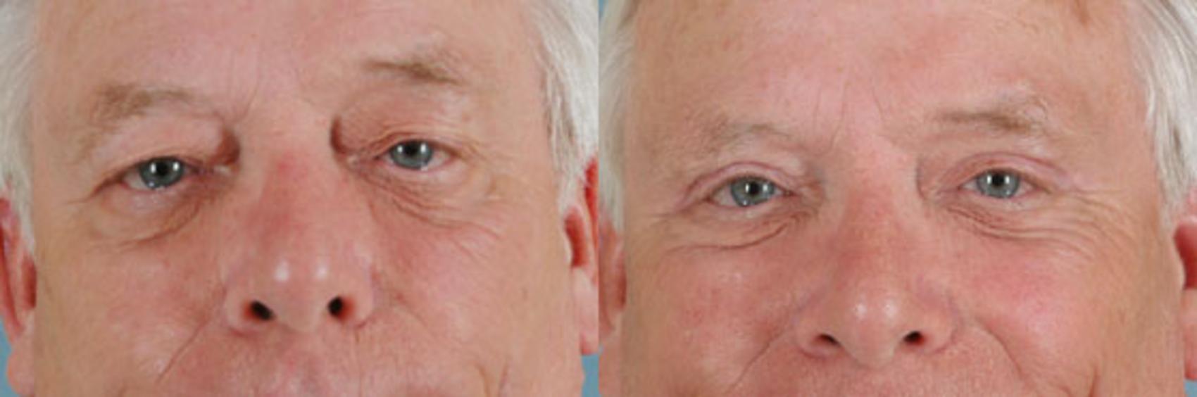 Before & After Eyelid Surgery (Blepharoplasty) Case 37 View #1 View in Tallahassee, FL