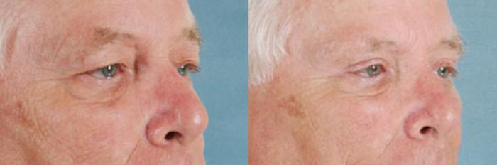 Before & After Eyelid Surgery (Blepharoplasty) Case 37 View #2 View in Tallahassee, FL