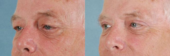 Before & After Eyelid Surgery (Blepharoplasty) Case 37 View #3 View in Tallahassee, FL