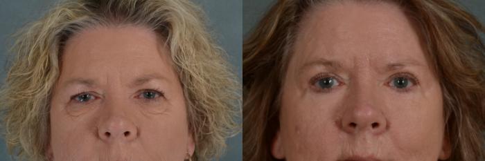 Before & After Eyelid Surgery (Blepharoplasty) Case 372 View #1 View in Tallahassee, FL