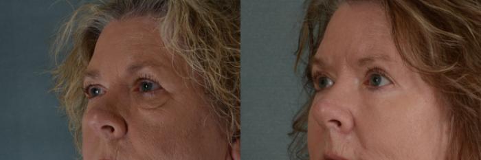Before & After Eyelid Surgery (Blepharoplasty) Case 372 View #2 View in Tallahassee, FL