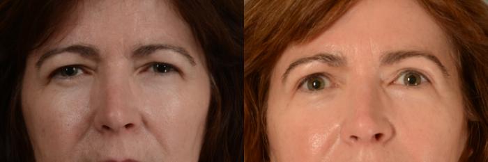 Before & After Eyelid Surgery (Blepharoplasty) Case 376 View #1 View in Tallahassee, FL