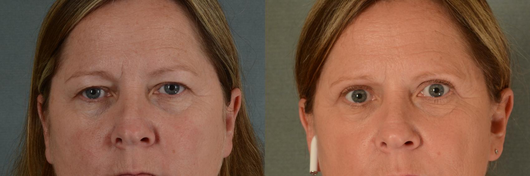 Before & After Eyelid Surgery (Blepharoplasty) Case 378 View #1 View in Tallahassee, FL