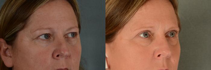 Before & After Eyelid Surgery (Blepharoplasty) Case 378 View #2 View in Tallahassee, FL