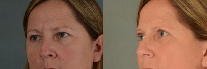 Before & After Eyelid Surgery (Blepharoplasty) Case 378 View #3 View in Tallahassee, FL