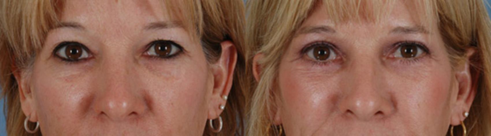 Before & After Eyelid Surgery (Blepharoplasty) Case 38 View #1 View in Tallahassee, FL
