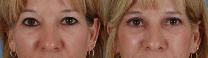 Before & After Eyelid Surgery (Blepharoplasty) Case 38 View #1 View in Tallahassee, FL