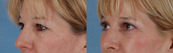 Before & After Eyelid Surgery (Blepharoplasty) Case 38 View #2 View in Tallahassee, FL