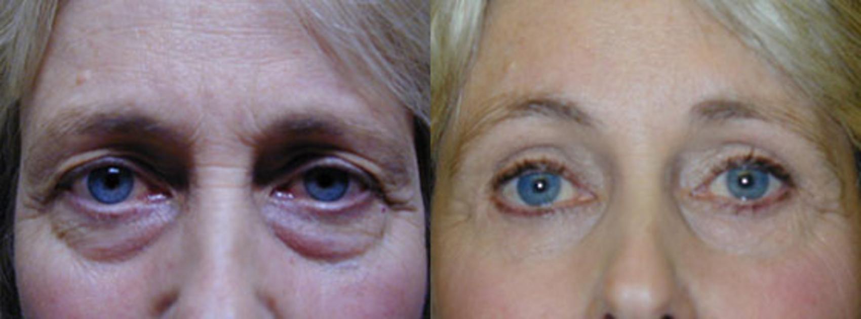 Before & After Eyelid Surgery (Blepharoplasty) Case 39 View #1 View in Tallahassee, FL