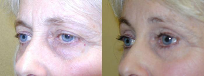 Before & After Eyelid Surgery (Blepharoplasty) Case 39 View #2 View in Tallahassee, FL