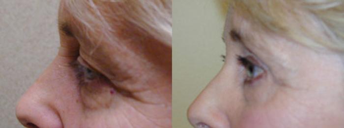 Before & After Eyelid Surgery (Blepharoplasty) Case 39 View #3 View in Tallahassee, FL