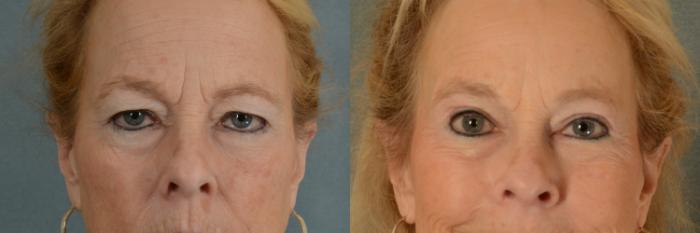Before & After Eyelid Surgery (Blepharoplasty) Case 393 View #1 View in Tallahassee, FL