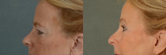 Before & After Eyelid Surgery (Blepharoplasty) Case 393 View #2 View in Tallahassee, FL