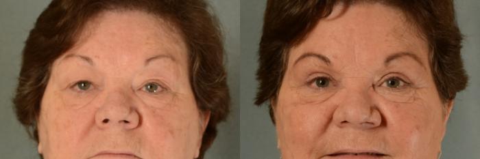 Before & After Eyelid Surgery (Blepharoplasty) Case 396 View #1 View in Tallahassee, FL