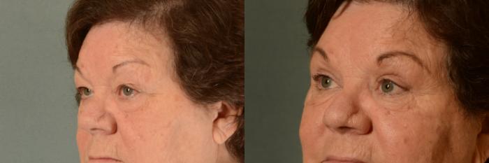 Before & After Eyelid Surgery (Blepharoplasty) Case 396 View #2 View in Tallahassee, FL