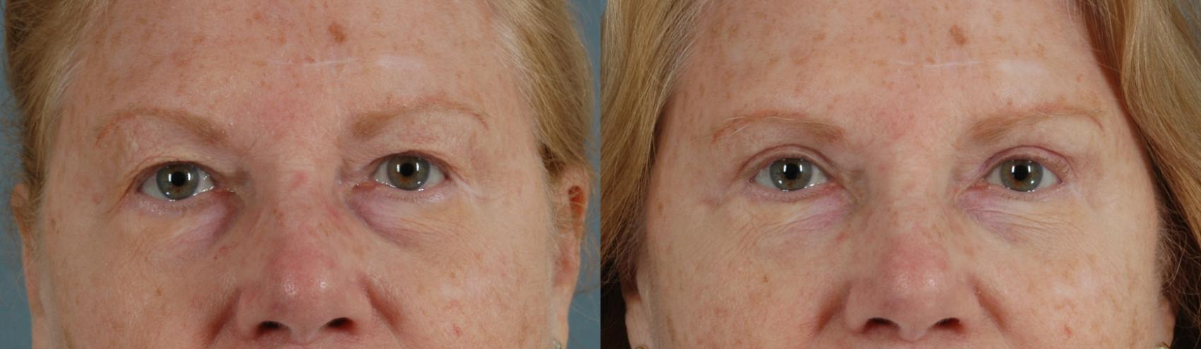 Before & After Eyelid Surgery (Blepharoplasty) Case 40 View #1 View in Tallahassee, FL