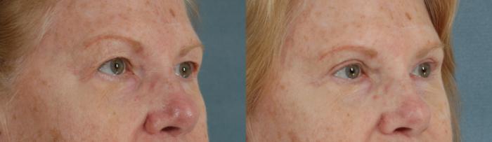 Before & After Eyelid Surgery (Blepharoplasty) Case 40 View #2 View in Tallahassee, FL