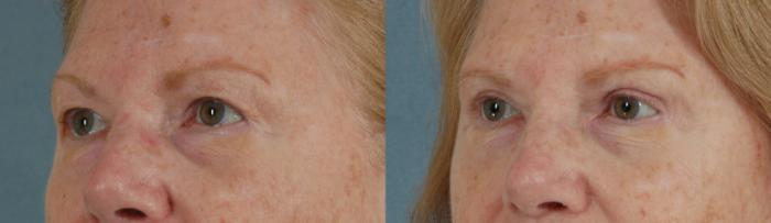 Before & After Eyelid Surgery (Blepharoplasty) Case 40 View #3 View in Tallahassee, FL