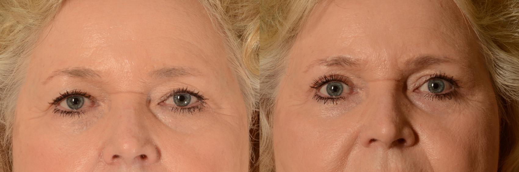 Before & After Eyelid Surgery (Blepharoplasty) Case 403 View #1 View in Tallahassee, FL