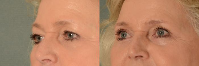 Before & After Eyelid Surgery (Blepharoplasty) Case 403 View #2 View in Tallahassee, FL