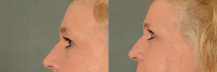 Before & After Eyelid Surgery (Blepharoplasty) Case 403 View #3 View in Tallahassee, FL