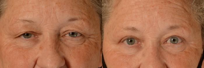 Before & After Eyelid Surgery (Blepharoplasty) Case 406 View #1 View in Tallahassee, FL