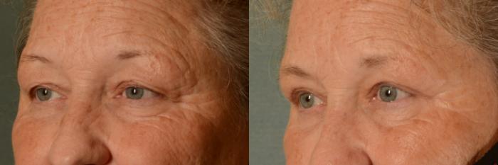 Before & After Eyelid Surgery (Blepharoplasty) Case 406 View #2 View in Tallahassee, FL