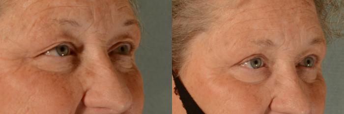 Before & After Eyelid Surgery (Blepharoplasty) Case 406 View #3 View in Tallahassee, FL