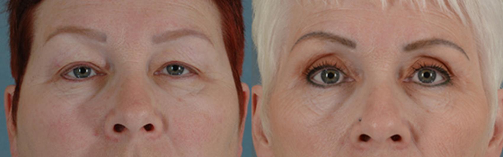 Before & After Eyelid Surgery (Blepharoplasty) Case 41 View #1 View in Tallahassee, FL